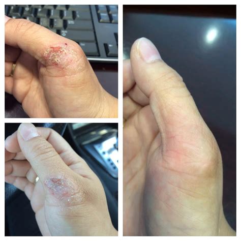 Eczema with diet changes : r/eczema