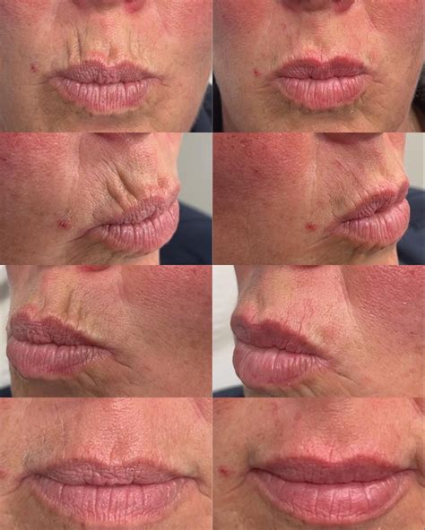 Smokers Lines Filler : A Comprehensive Guide