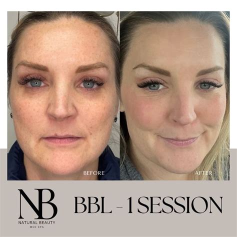 IPL PhotoFacial with BBL | Huntington, Long Island