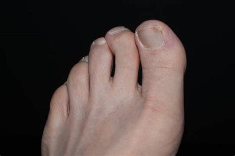 Curved Toenails Stock Photos, Pictures & Royalty-Free Images - iStock