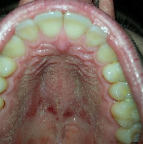 Oral Herpes Roof Of Mouth