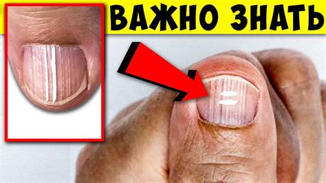 Почему появились Полоски на Ногтях ! Откуда они и Что делать... - YouTube