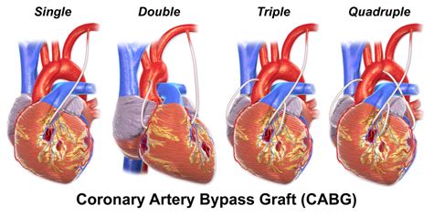 coronary artery bypass graft physiopedia