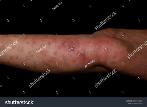 staphylococcal streptococcal skin infection bullous impetigo stock