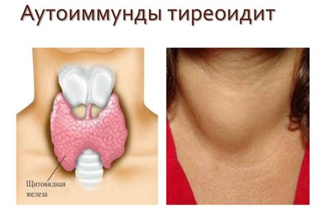 Аутоиммунный тиреоидит проявления на коже - фото презентация