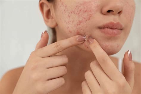 Effective Dermatological Treatments For Removing Stubborn Blackheads On Lips And Preventing Them From Returning In The Future 1