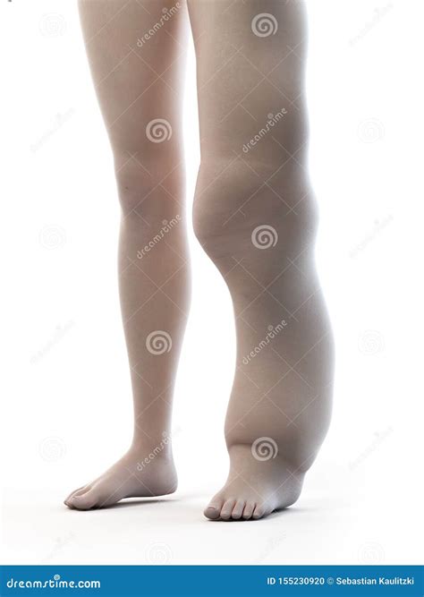 Lymphedema Cartoon Vector | CartoonDealer.com #54399607
