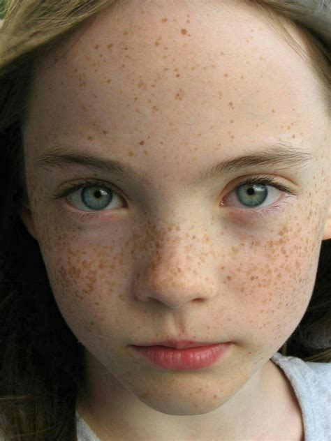 on Freckles
