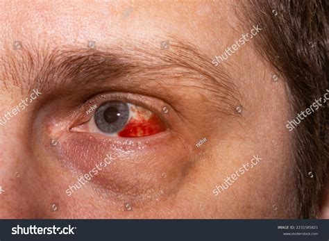 403 Damage Cornea Eye Images, Stock Photos & Vectors | Shutterstock