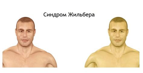 Что такое синдром Жильбера простыми словами?