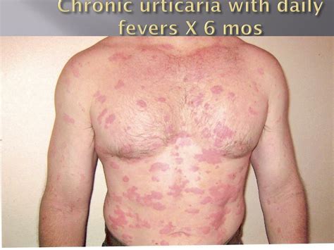 cutaneous  urticarial vasculitis powerpoint