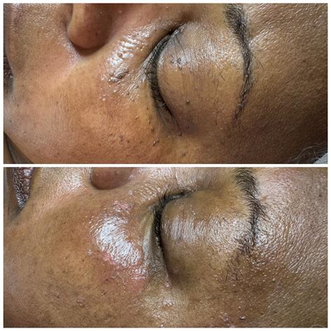 Skin - Thermoclear treats skin tags, keratosis, sebaceous hyperplasia