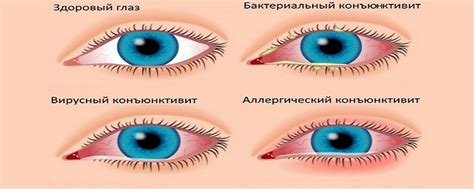 Герпетический конъюнктивит: симптомы, лечение