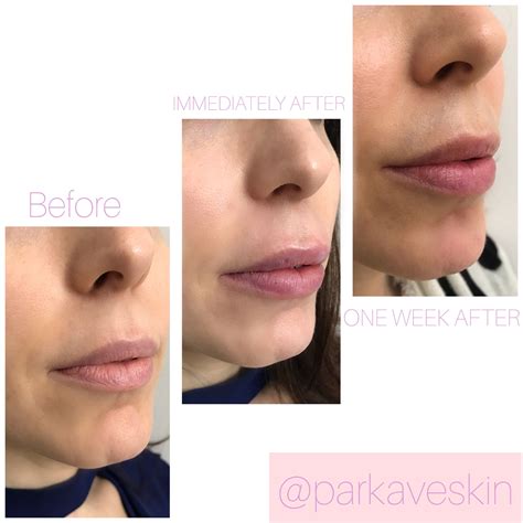 I Tried Lip Fillers For The First Time--Here's Everything You Need To ...