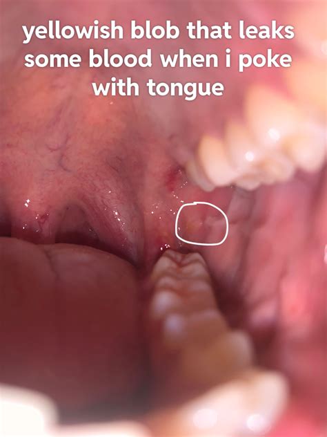 Wisdom tooth infected?? : r/wisdomteeth