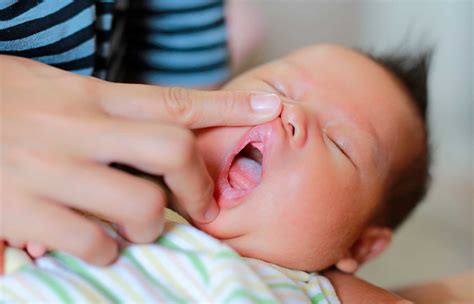 Bebe Com A Lingua Branca - Língua do bebê branca pode indicar problemas bucais? Saiba o que fazer ...