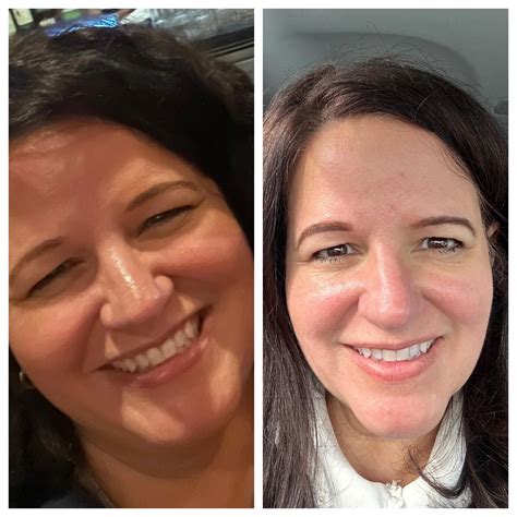 Ozempic Face Understanding The Weight Loss Drug Side Effects - Weight