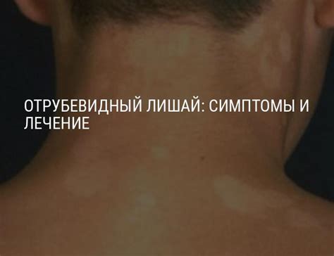 Отрубевидный лишай у человека: лечение отрубевидного разноцветного лишая