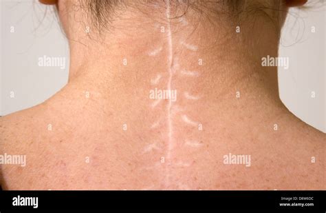 Discectomy Scar Neck