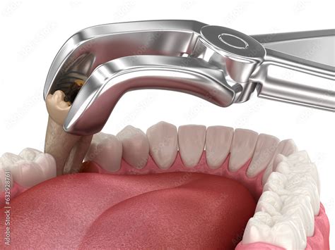 Extraction of Molar tooth damaged by caries. Dental 3D illustration ...