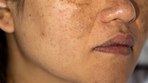 Hyperpigmentation — Wild Science Lab