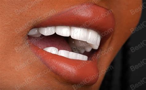 faccette dentali emax turchia prezzi  istanbul guida