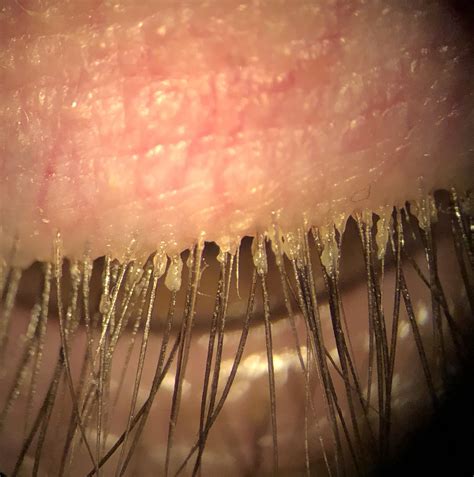 Overcoming Mite Fright: How to Talk to Patients about Demodex Blepharitis