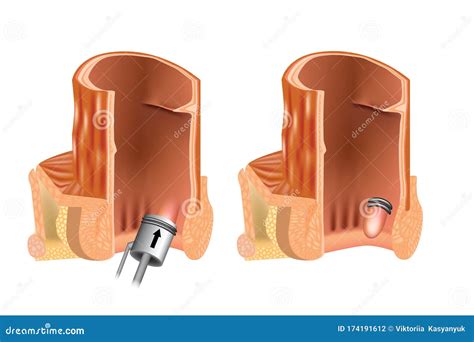 Rubber Band Ligation Of Hemorrhoid Vector Illustration | CartoonDealer ...