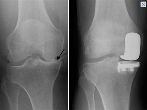 What is a partial knee replacement? - OSMS - Orthopedic and ...