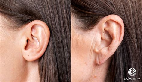lobulo da orelha anexado lobulo orelha acoplado lobulo orelha livre