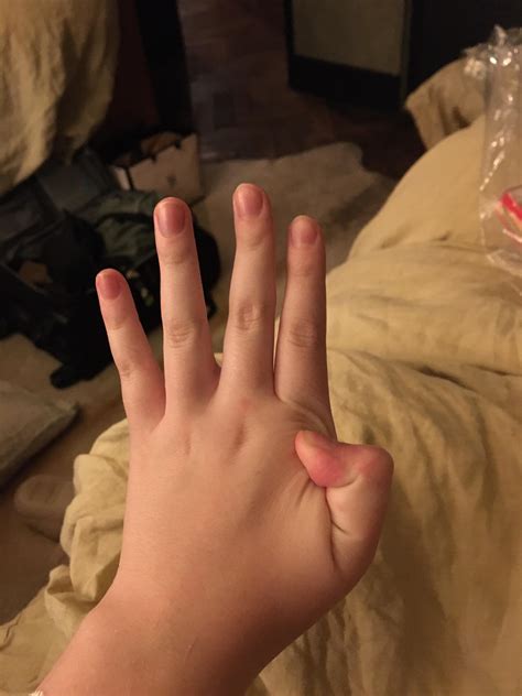 Are these examples of hyper mobility in hands? : r/eds