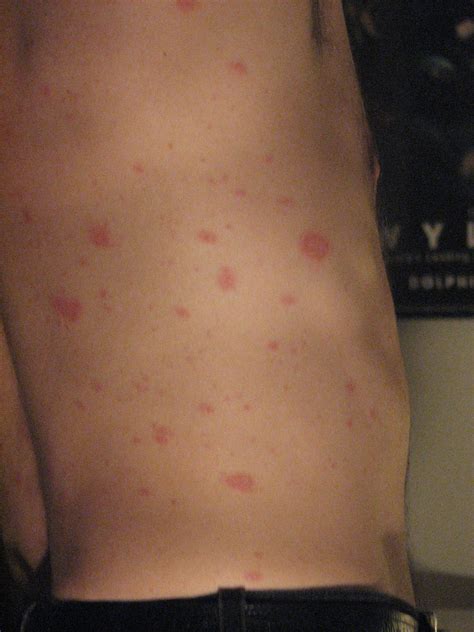 pityriasis rosea pic - pictures, photos