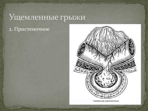 Операции на передней брюшной стенке. Грыжи и герниопластика ...