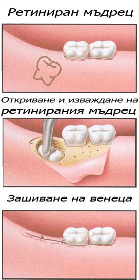 Оперативно изваждане на ретиниран мъдрец | Д-р Ралев - зъболекар