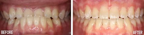 Before and After - Kamisugi and Kawamoto Orthodontics | Aiea Mililani HI