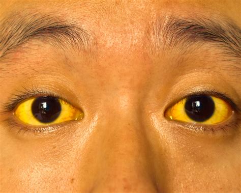 Yellow Eyes Causes And Treatment - Infoupdate.org