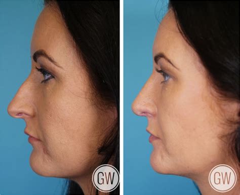rhinoplasty gallery rhinoplastyperth