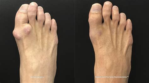 arthritic big toe foot  podiatry centers