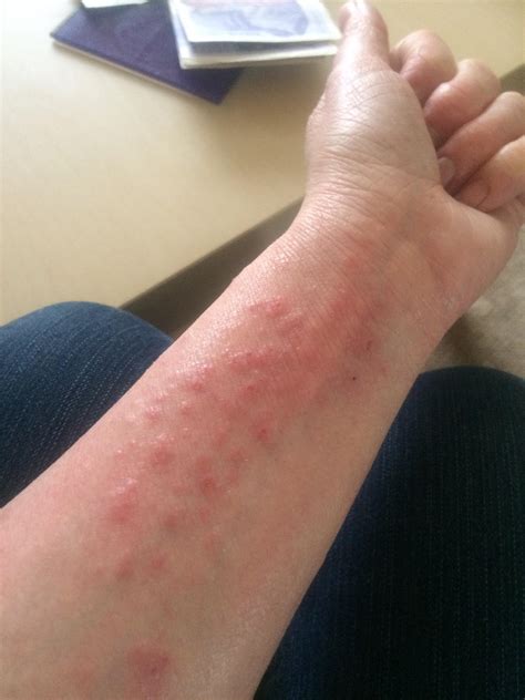 Itchy, inflamed, dry lips ): anyone know what this is? : r/eczema