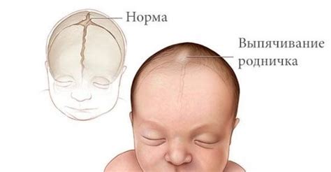 Когда должен закрыться родничок у ребенка норма