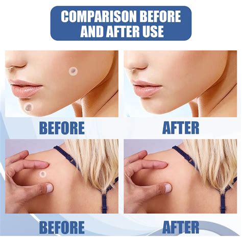 Skin Filamentous Calming Verruca Corns Patch Plantar Verruca Cure