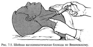 Шейная вагосимпатическая блокада по Вишневскому.
