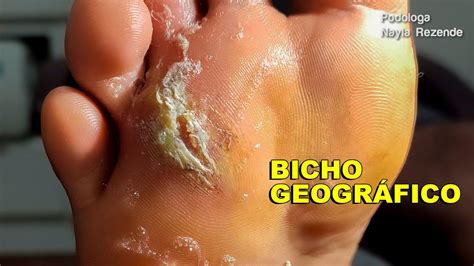 Como Matar O Bicho Geográfico - Bicho Geográfico - Como tratar Bicho Geográfico (Vipé Podologia) - YouTube