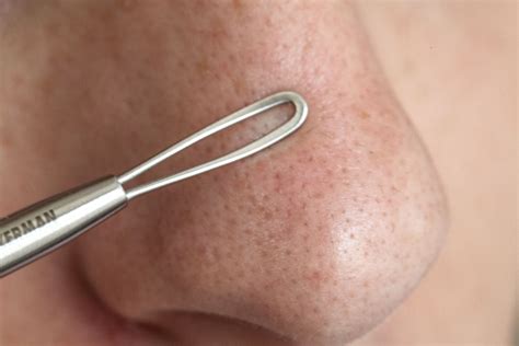The Most Effective Unbelievable Blackhead Removal 2024 Techniques, Ranked! Image 15