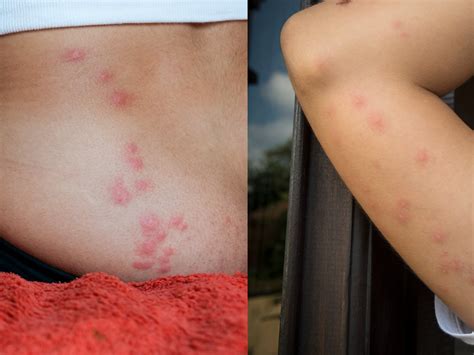 Bed Bug Bites Decoded: Symptoms, Treatments, and Prevention Tips ...