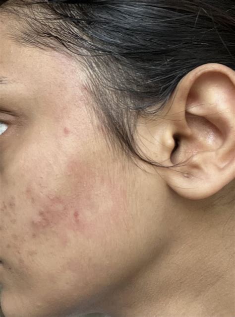 Reaction from aloe Vera gel? : r/Skincare_Addiction