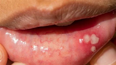 Mouth Sores: Pictures, Causes, Types, Symptoms, and Treatments Blister In Mouth, Mouth Blisters ...