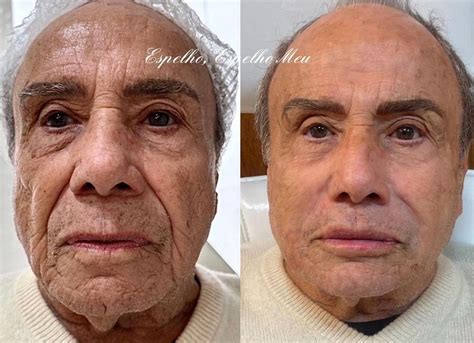 Capuzplastia Antes E Depois - Lauana Prado passa por harmonização facial; veja antes e depois