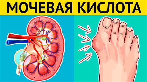 МОЧЕВАЯ КИСЛОТА: что способствует накоплению, КАК ВЫВЕСТИ? Последствия ...