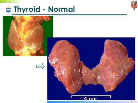 normal thyroid gross